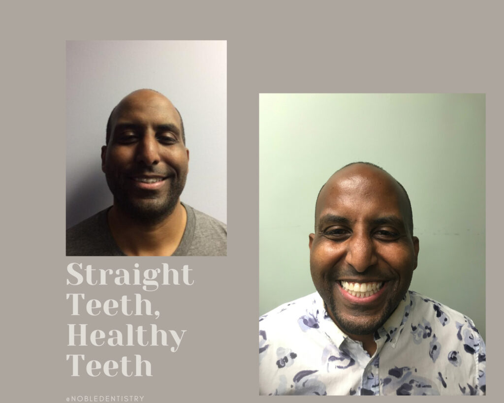 Invisalign Brooklyn| Noble Dental Care- Sample photo of the client(1)